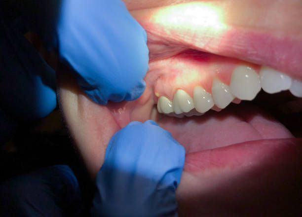 Best Emergency Dental Care for Broken or Chipped Teeth in Moss Point, MS