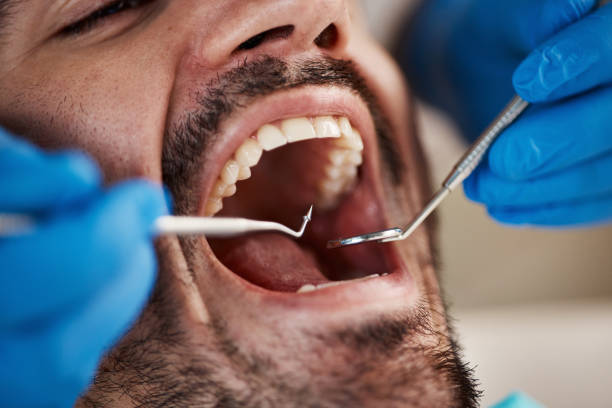 Best Emergency Root Canal Treatment in Moss Point, MS