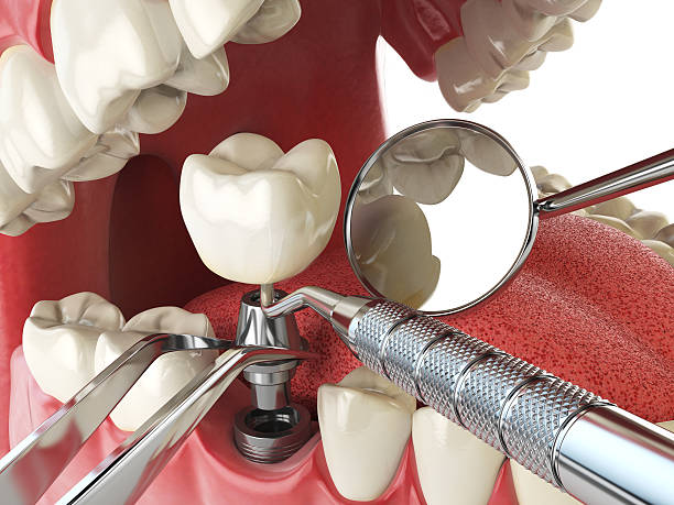 Best Emergency Tooth Extraction in Moss Point, MS